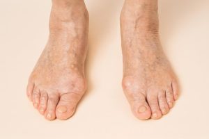 Arthrose du gros orteil